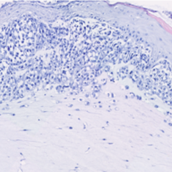 FULLY DIFFERENTIATED SKIN & METASTATIC MELANOMA